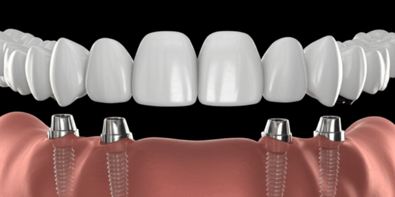 Are All on 4 Dental Implants Permanent Understanding Lifespan Durability and What Permanent Really Means