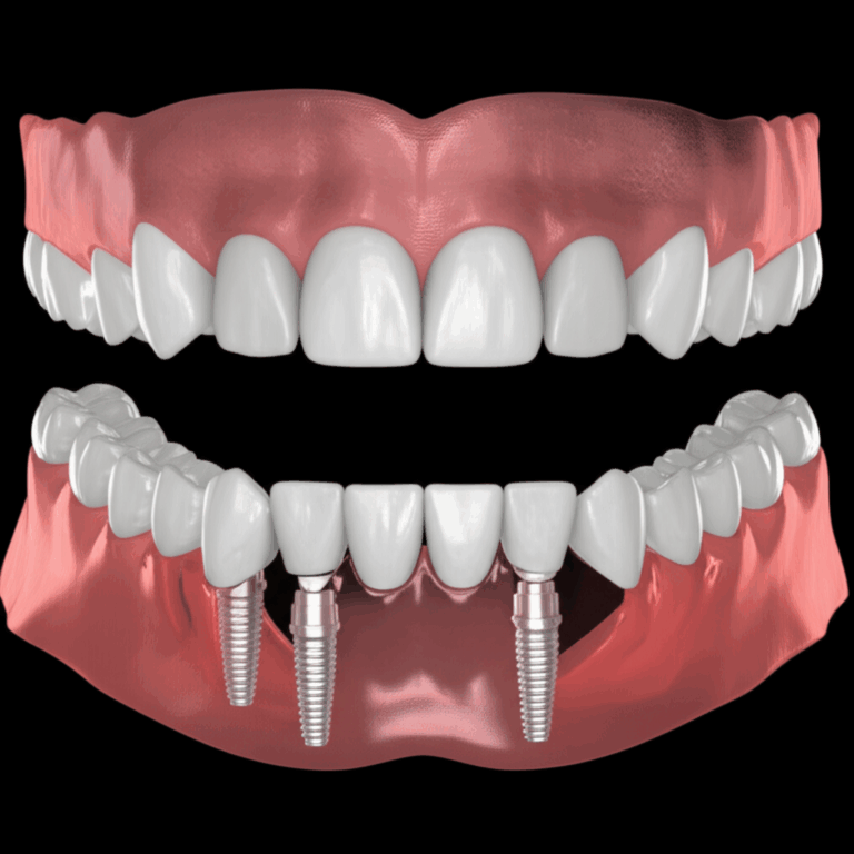 Are All on 4 Dental Implants Removable My Firsthand Journey Through Fixed vs. Removable Dental Solutions