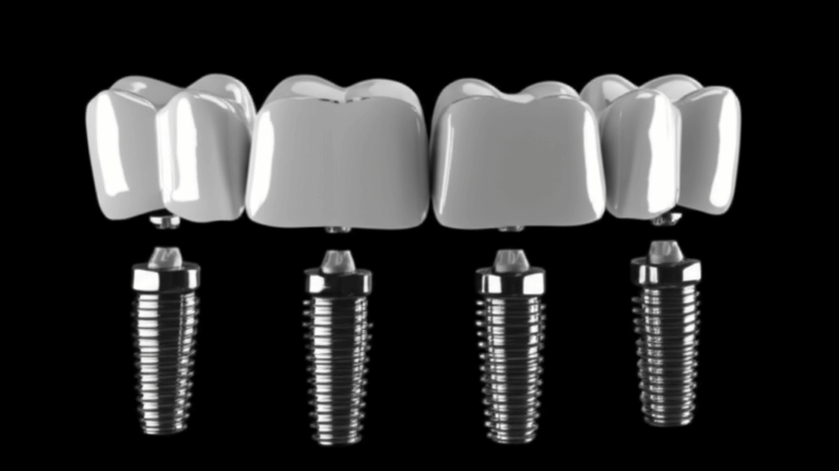 Are All on 4 Dental Implants Worth It A Personal Guide to Value Cost Long Term Benefits