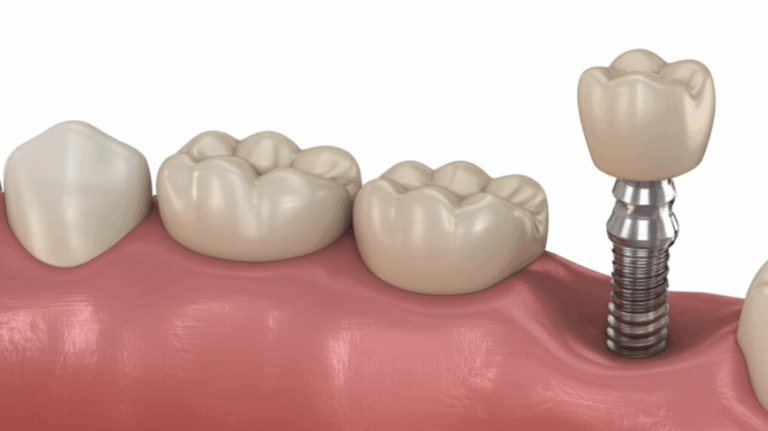 Are Crowns Dental Implants Understanding the Key Differences and Connections