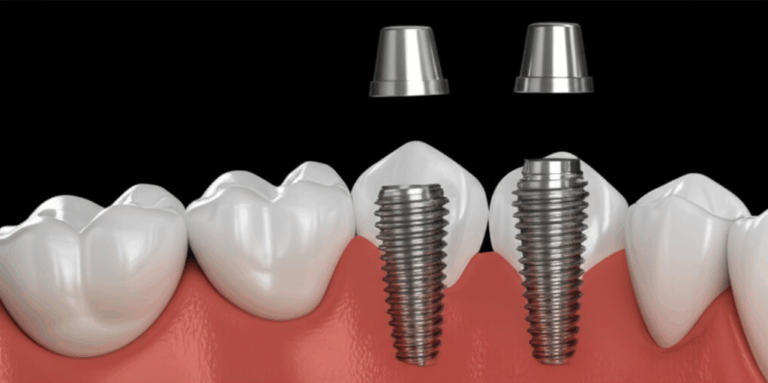 Are Dental Implants As Strong As Natural Teeth A Comprehensive Comparison
