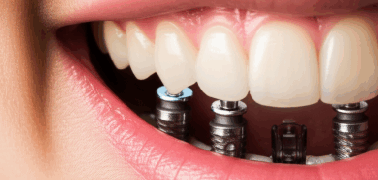 Are Dental Implants Considered Major Restorative Dentistry Understanding Classification Coverage and Cost