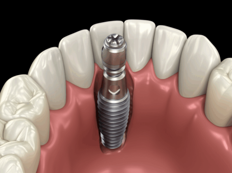 Are Dental Implants Screwed Into the Bone My Personal Journey Through the Science and Experience