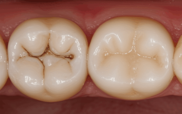 Can You Get Veneers on Teeth with Root Canal A Simple First Person Guide
