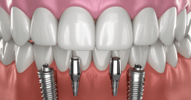 Dental Implants Are They Permanent or Removable Unpacking the Truth
