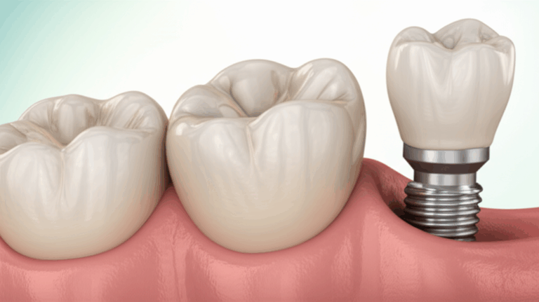 Dental Implants vs. Crowns Which Tooth Restoration Is Right for You A Caring Easy Guide