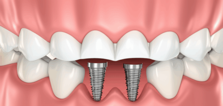 Dental Implants vs. Veneers Which Is Right for Your Smile My Candid Experience Guide