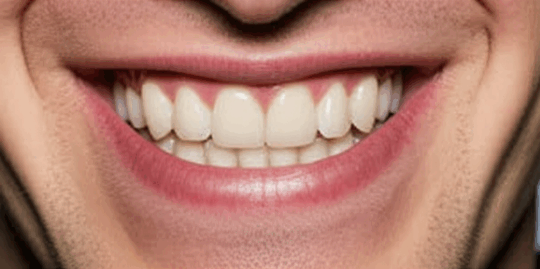 Did Alan Ritchson Have Veneers Unpacking the Reacher Star s Smile Transformation