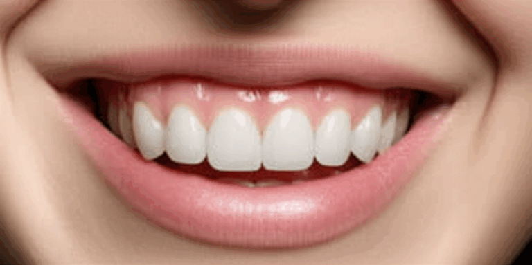 How Long Do All on 4 Dental Implants Really Last