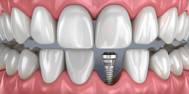 Veneers vs. Dental Implants What I Learned About the Difference And How to Choose